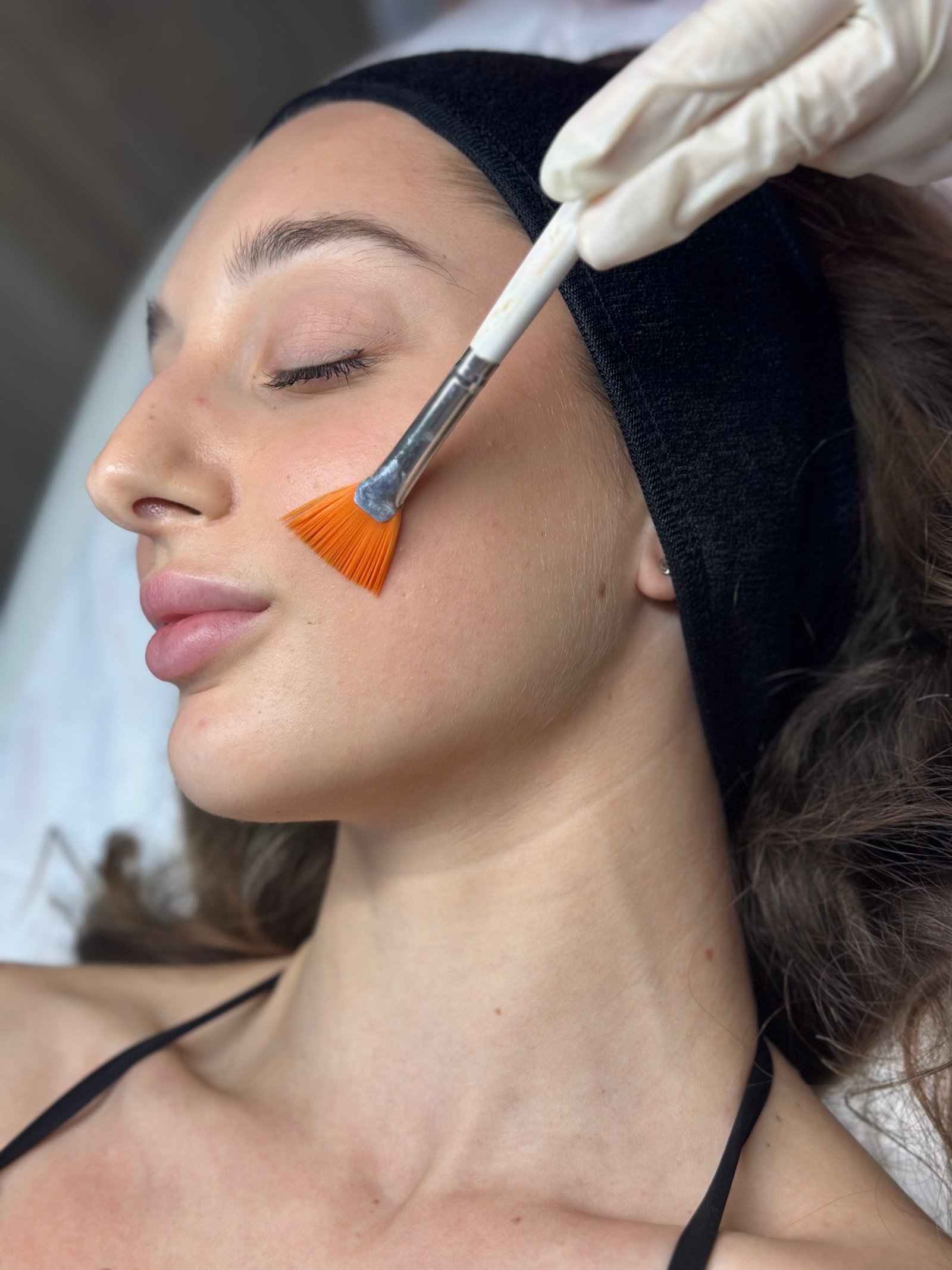 Χημικά Peelings